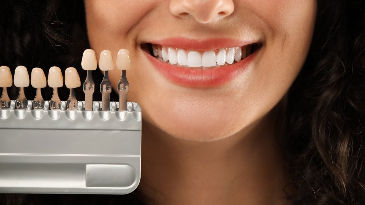 Porcelain Veneers in Greece: Procedure, Benefits, and What to Expect